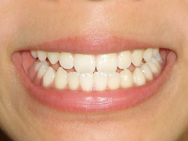 重曹うがい が虫歯予防に効果あり 正しい重曹うがいのやり方 歯科