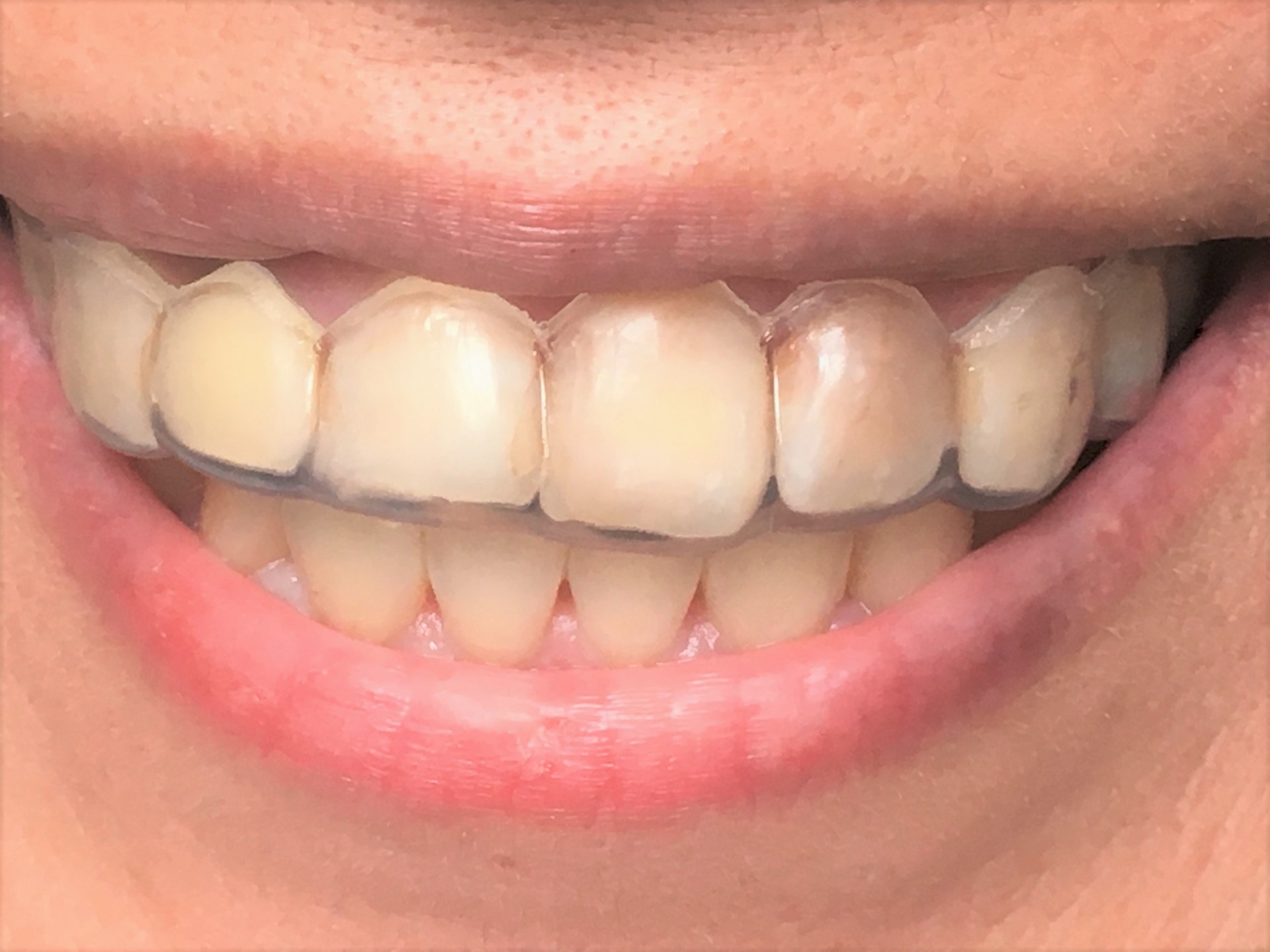マウスピース矯正で歯茎が痛い 腫れた 歯茎のトラブルと予防法 歯科オンライン
