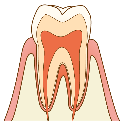 基礎知識編 今さら聞けない虫歯の治療法や話題の3mix Mp法とは 歯科オンライン
