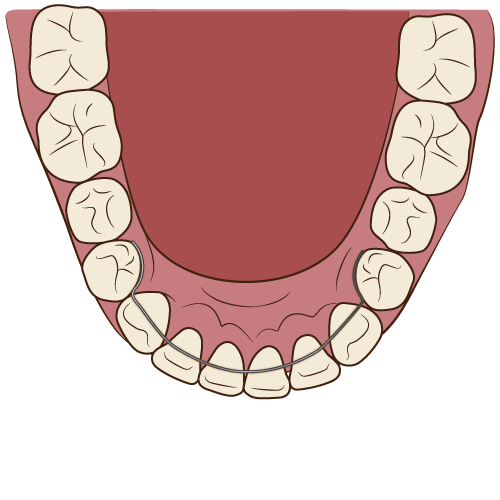 リテーナーの価格はどのくらい 矯正治療の料金が違う理由 歯科オンライン
