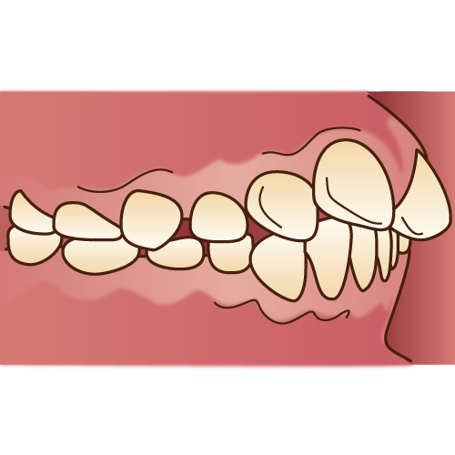 出っ歯の矯正で健康保険が利くのはどんなとき 医療控除は受けられる 歯科オンライン