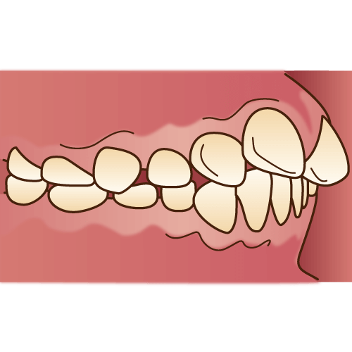 噛み合わせ矯正で保険を使えることがある 保険適用できる3つのケース 歯科オンライン