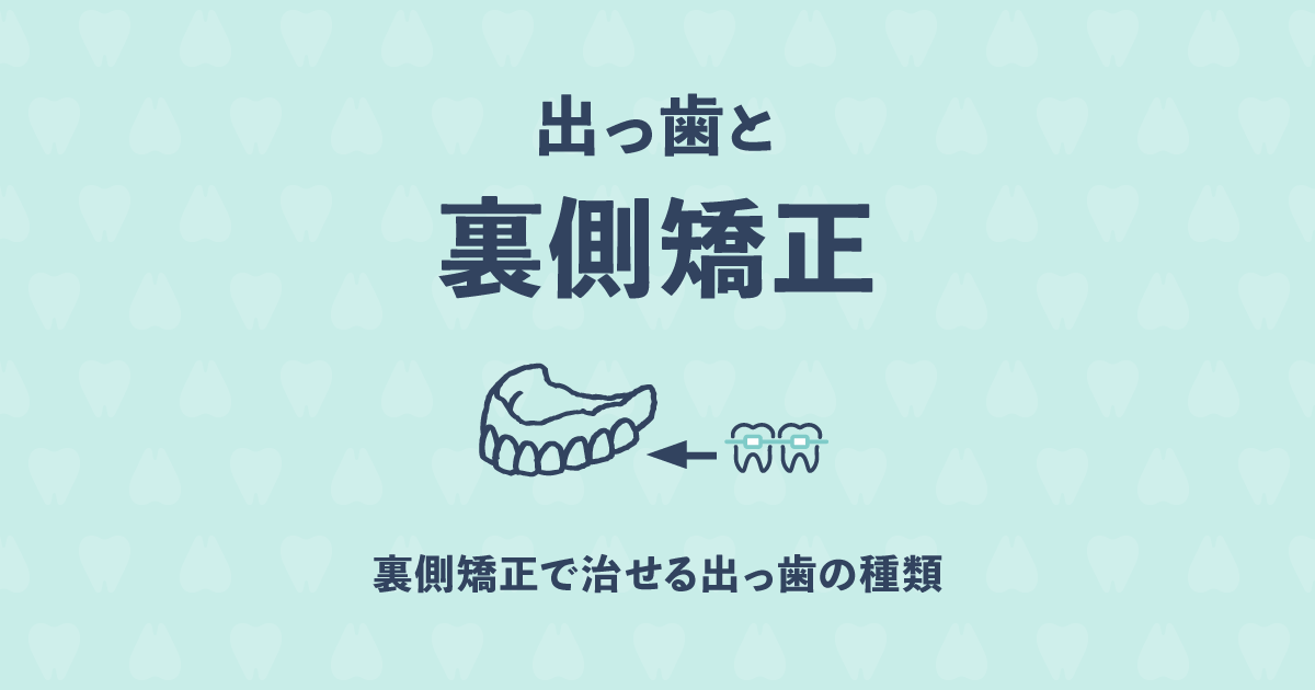 出っ歯を歯の内側で矯正するメリットとデメリットを教えて!
