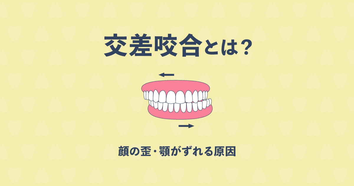 交差咬合とは?顔の歪みや顎がずれる原因と治療法について