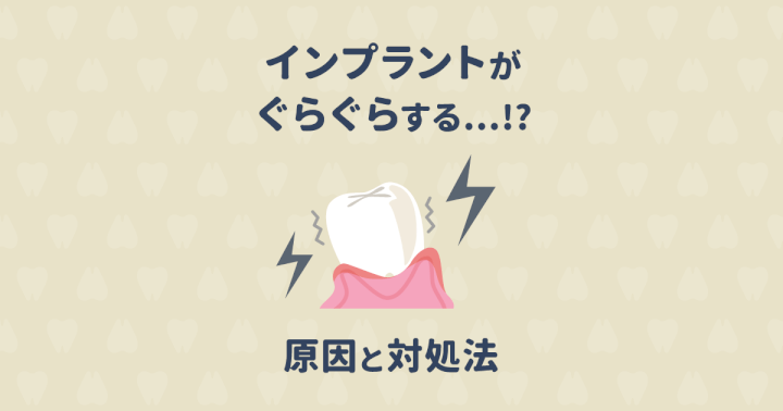 インプラントがぐらぐらして心配!原因と対処法・予防について