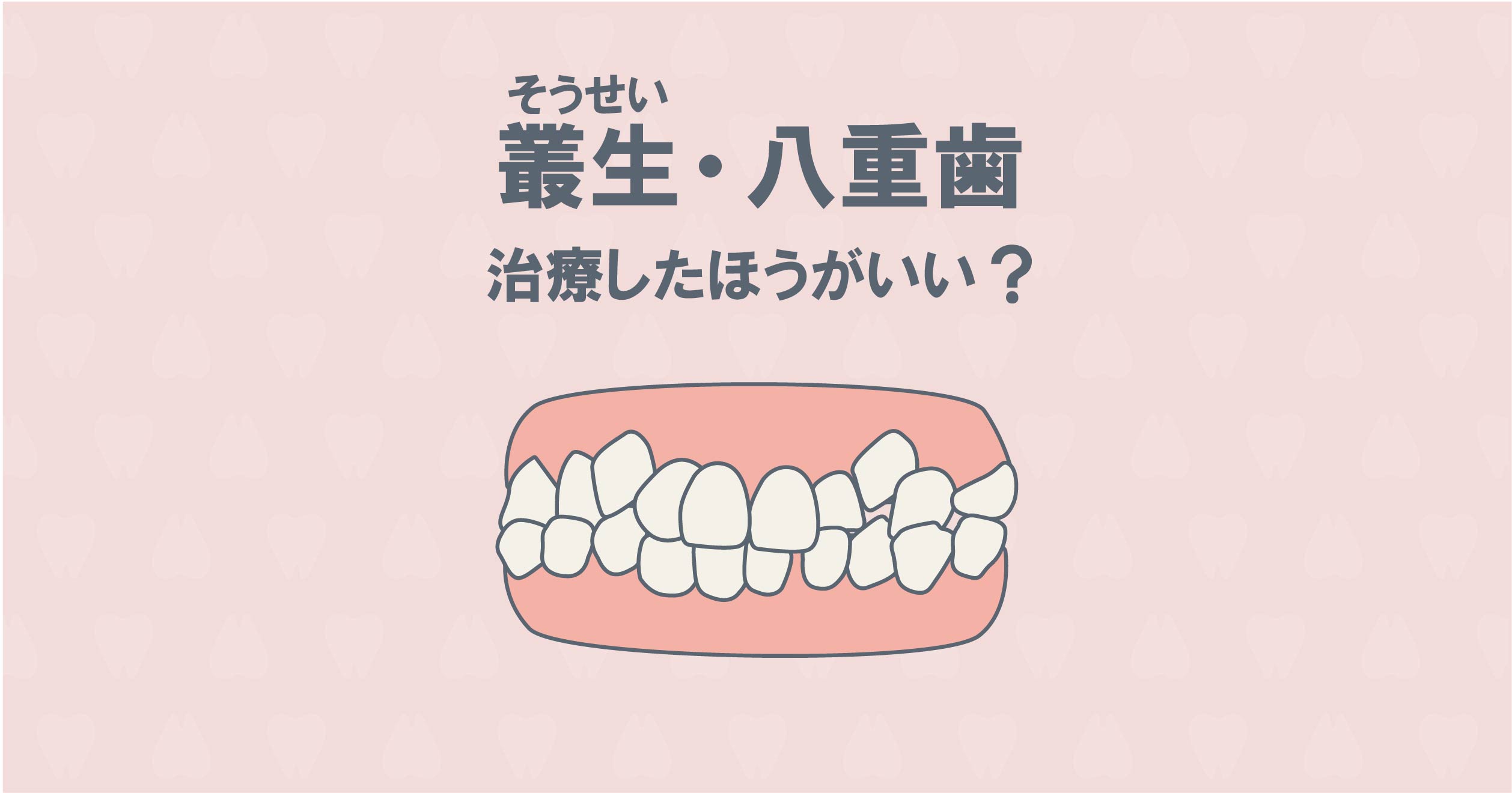 叢生（そうせい）・八重歯は矯正すべき？治療の疑問にお答えします